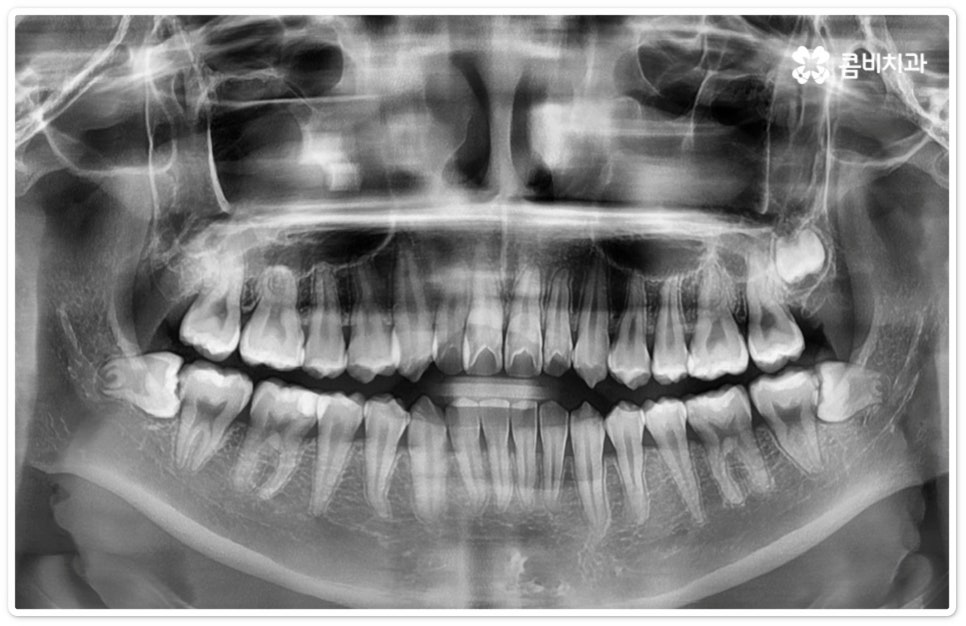 누운사랑니발치 이모저모 알아봐요 관련 이미지 5