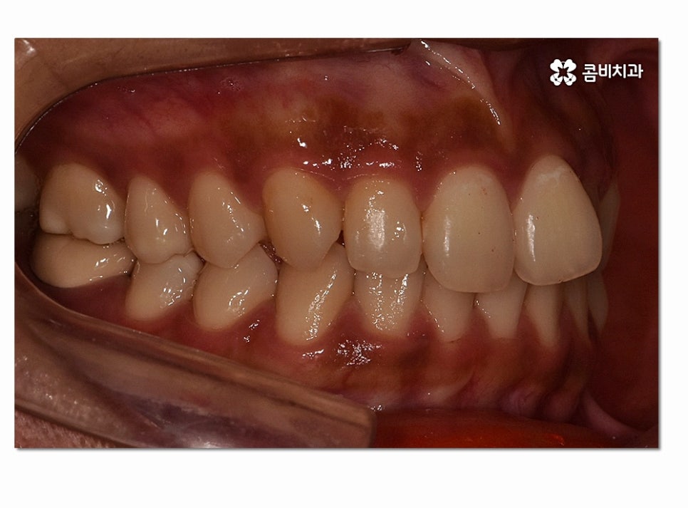 앞니 부분교정 오래 걸리지 않고 원하는 부위만 관련 이미지 2