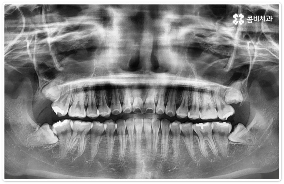 누운사랑니발치 이모저모 알아봐요 관련 이미지 8