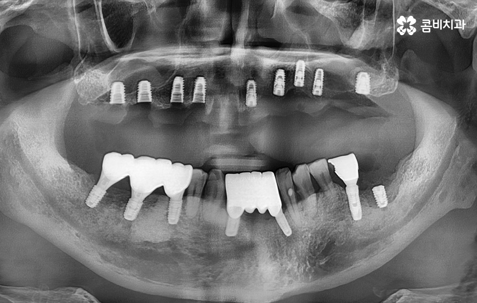 노인임플란트 이것만큼은 기억하세요 관련 이미지 12