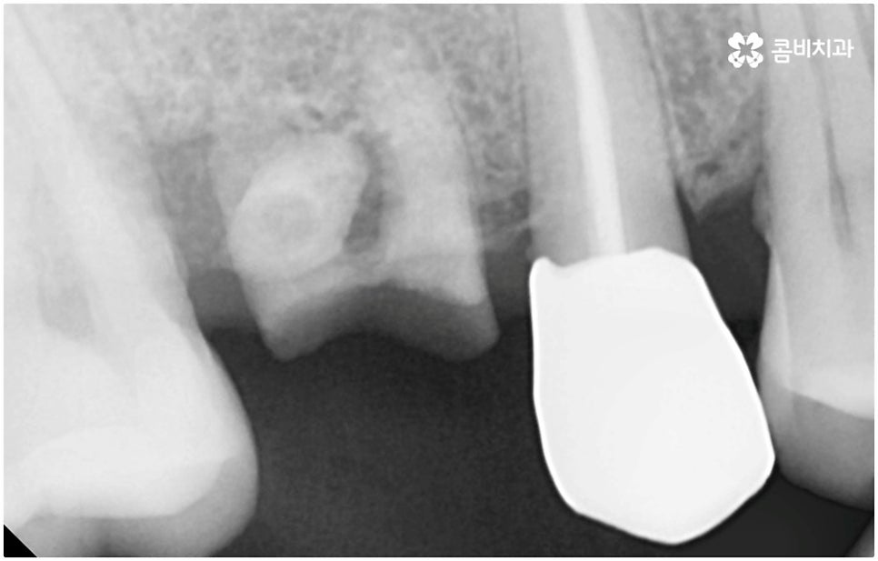 발치후 임플란트 바로 되나요? 관련 이미지 12
