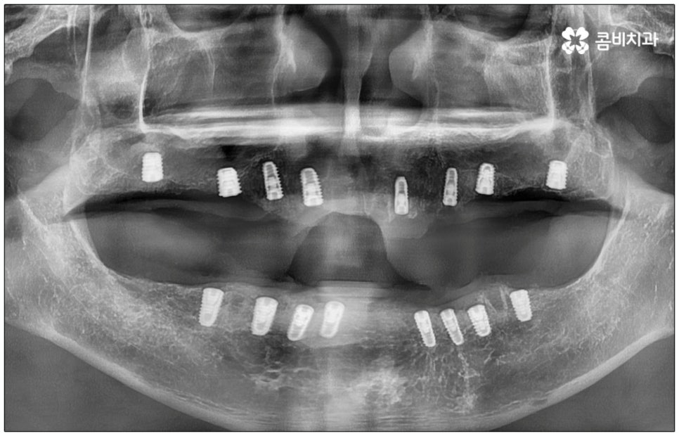 노인임플란트 참고사항 알아봐요 관련 이미지 11