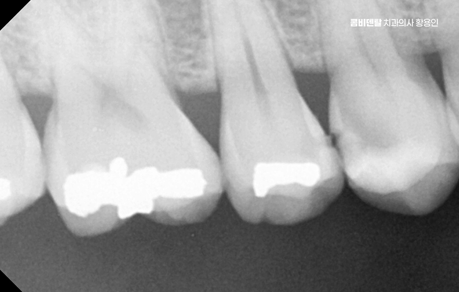 아말감 교체 레진 인레이 어떻게 대처하면 될까 관련 이미지 6