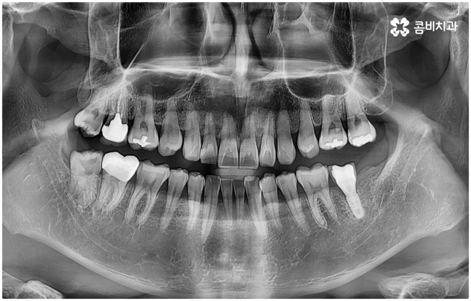 매복사랑니발치치과 어디로 가나요? 관련 이미지 1