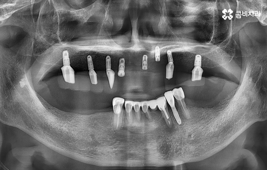 임플란트 나이 얼마나 영향을 줄까 관련 이미지 9