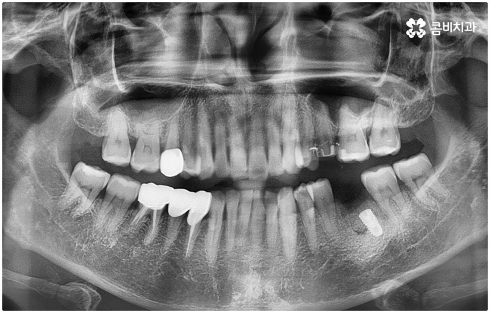 원데이임플란트 받고 싶으신가요? 관련 이미지 9