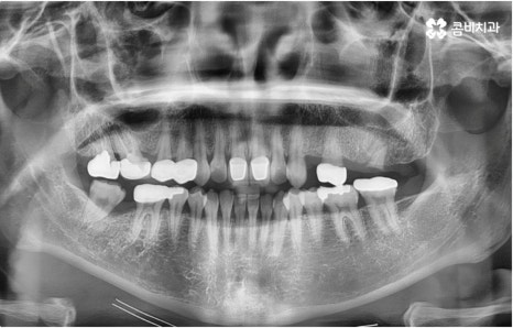 명동치과 타고난 이의 수명은 관련 이미지 1