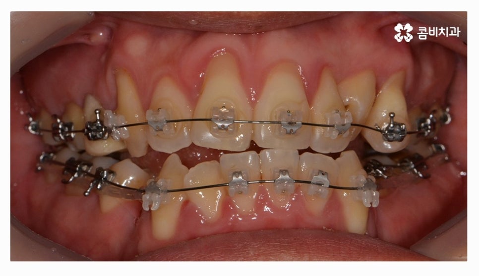 클리피씨교정 올바르게 판단하려면 관련 이미지 7