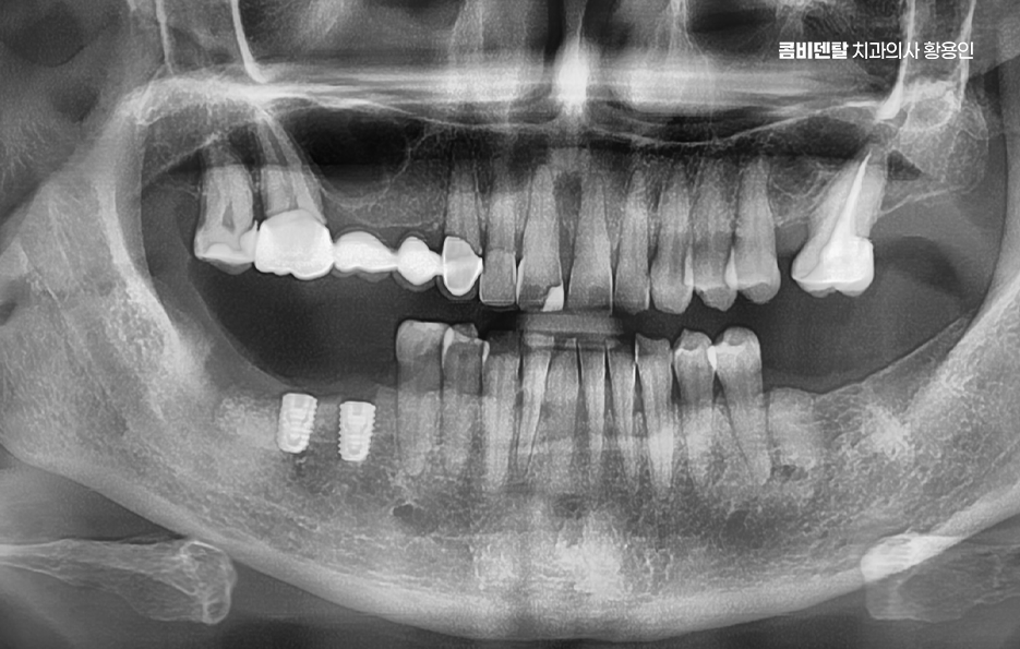 임플란트의 장점 할까 말까 고민이신 분들을 위한 정리 관련 이미지 3