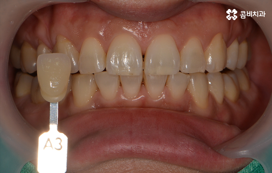 치과미백치료 누런 이가 고민되신다면 관련 이미지 1