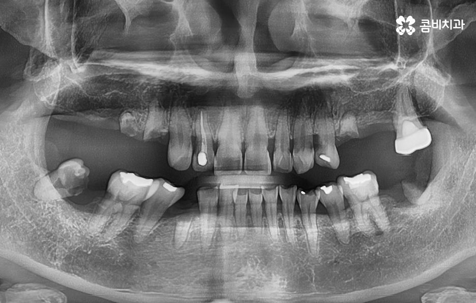 임플란트 치료기간 어느정도 걸리고 치과에는 몇번 가나요 관련 이미지 1
