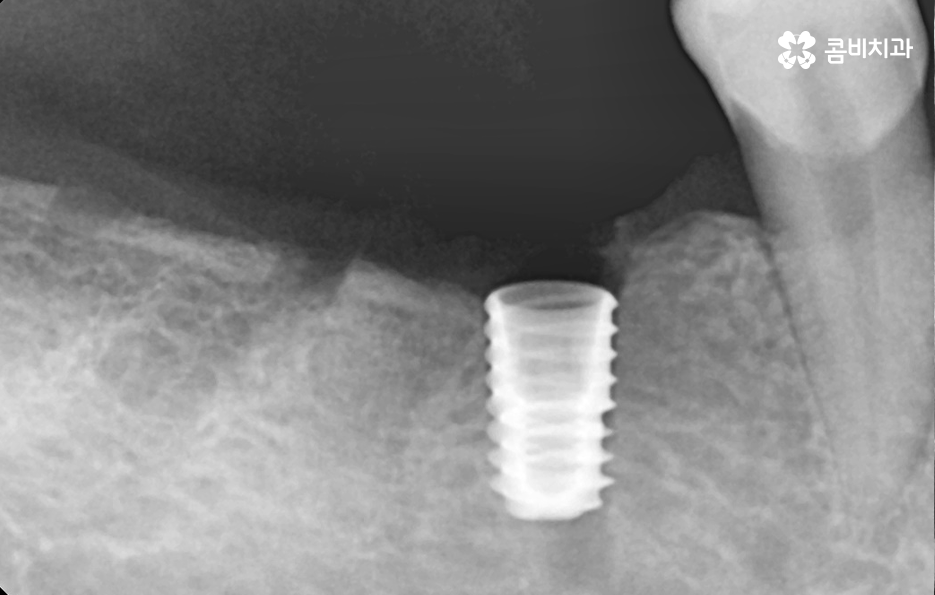 40대임플란트 치과에 이건 알고 가세요 관련 이미지 2