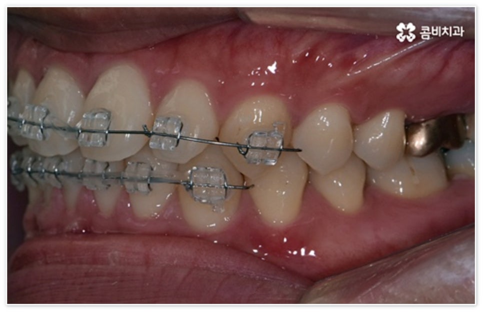앞니 벌어짐 고치고 싶어요 관련 이미지 7