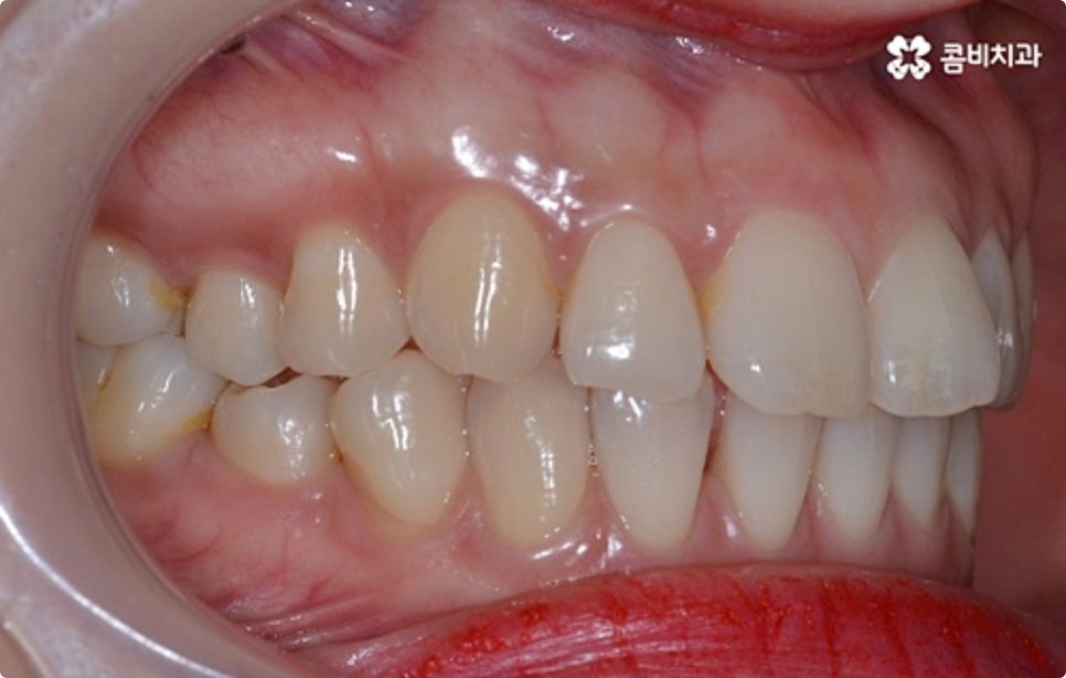 직장인치아교정 어떻게 시작하나요? 관련 이미지 6