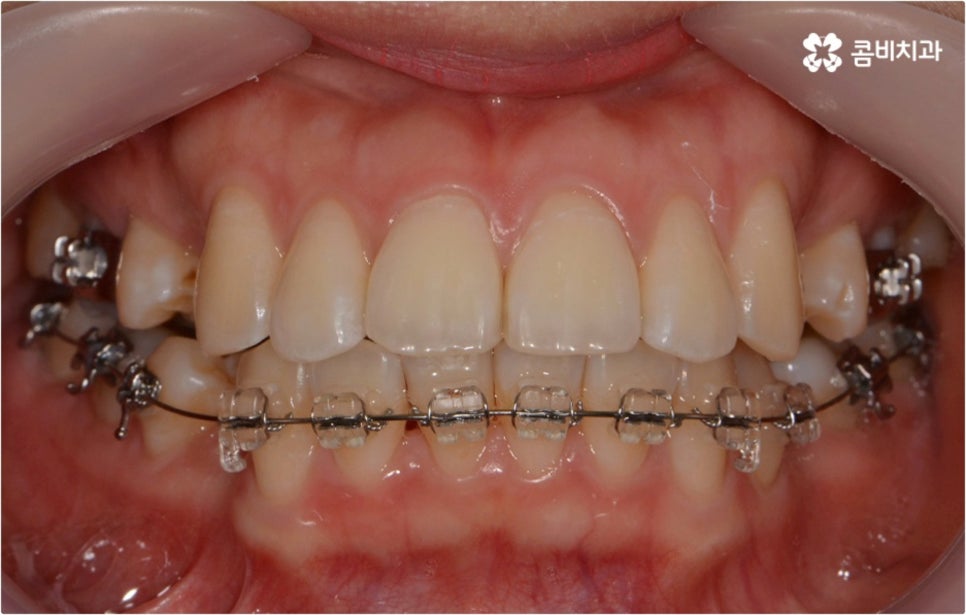 돌출입 치아교정 부모와 아이가 함께 알아봐요 관련 이미지 4