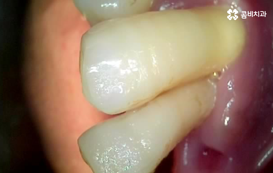 치아 옆면 충치 이렇게 무섭습니다 관련 이미지 2