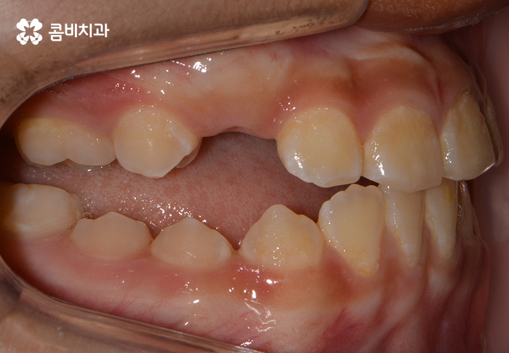 성장기치아교정 어떻게 접근하는 것이 좋을까 관련 이미지 4