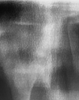 어금니 뒤 잇몸 부음 어떤 문제길래 이런거죠 관련 이미지 13