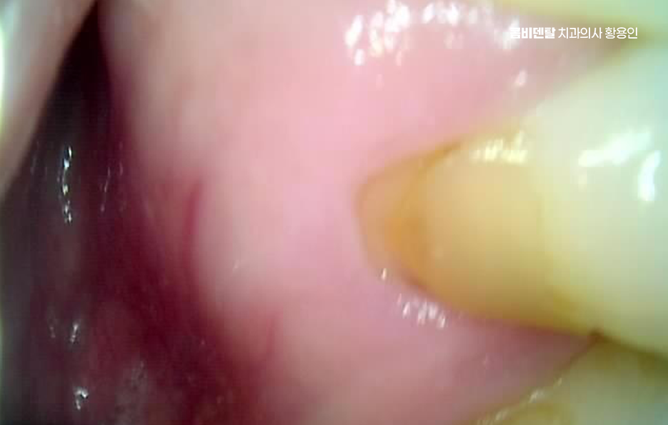 치경부마모증 치료 과정 신중하게 준비하려면 관련 이미지 5
