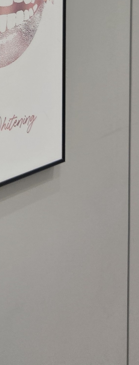 앞니 크라운 교체 깔끔하게 정리하려면 관련 이미지 40