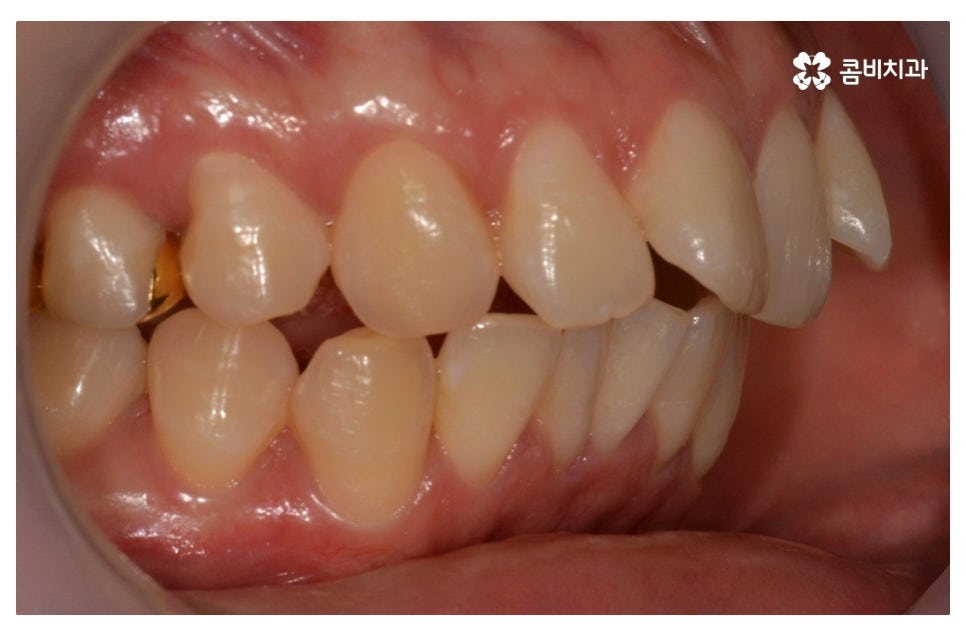 덧니교정 정확하게 알아보려면 관련 이미지 3
