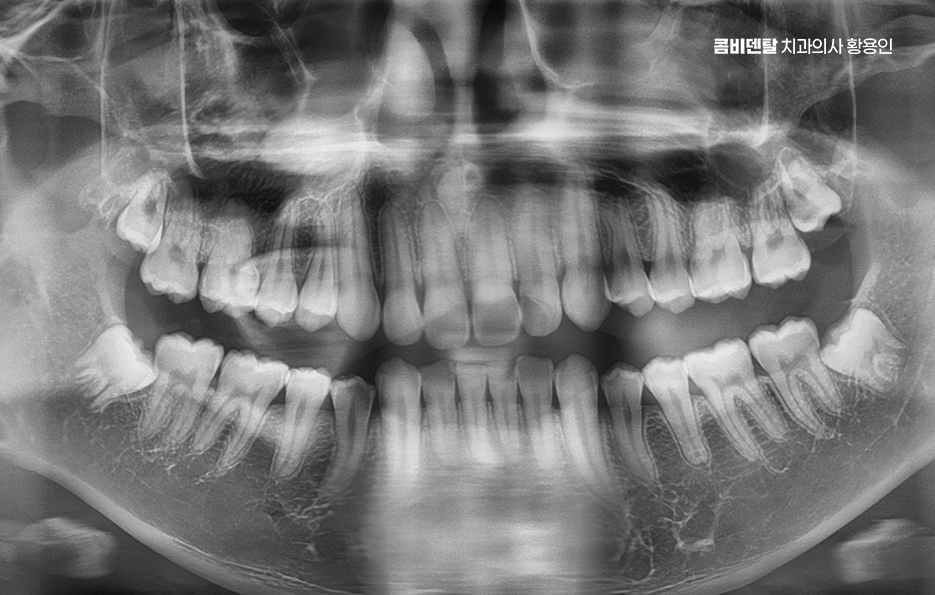 완전매복사랑니 발치 대학병원 꼭 가야하나요 관련 이미지 1