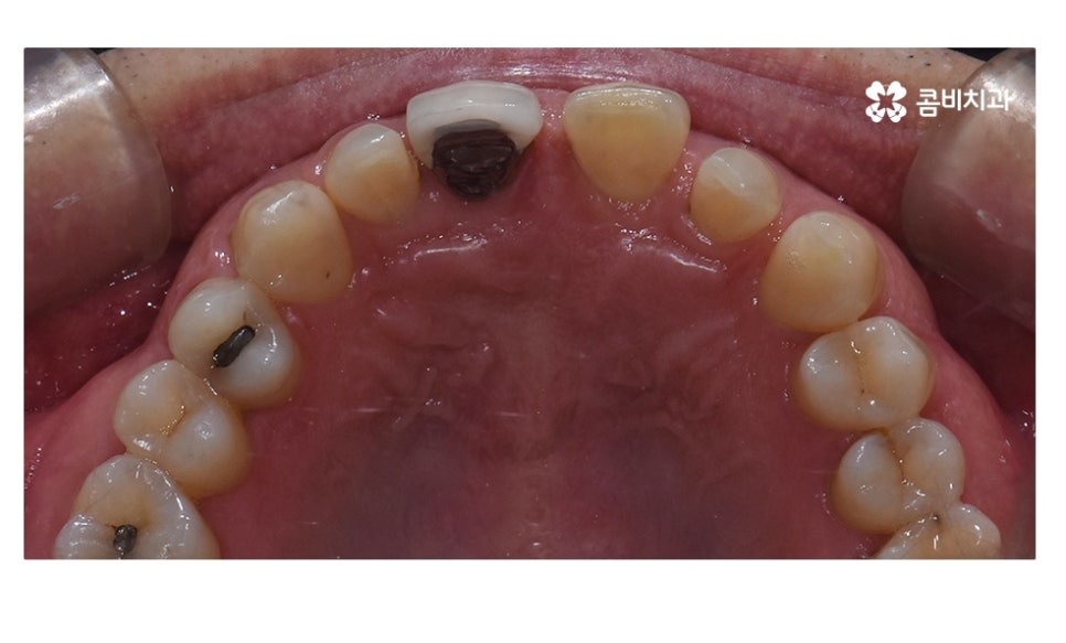 무삭제라미네이트 포인트부터 잘 알고 시작하려면 관련 이미지 3
