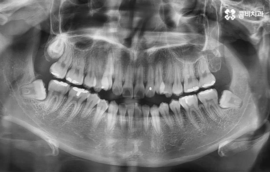 송곳니 덧니 뽑지 않고 해결된 사례 관련 이미지 6