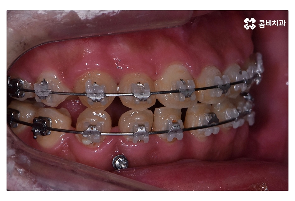 클리피씨교정 늦지않게 결정하려면 관련 이미지 12