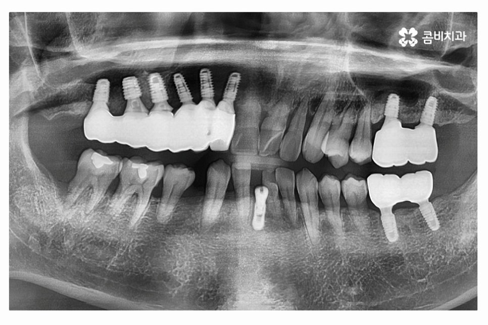 임플란트 수술 신중하게 결정하려면 관련 이미지 9