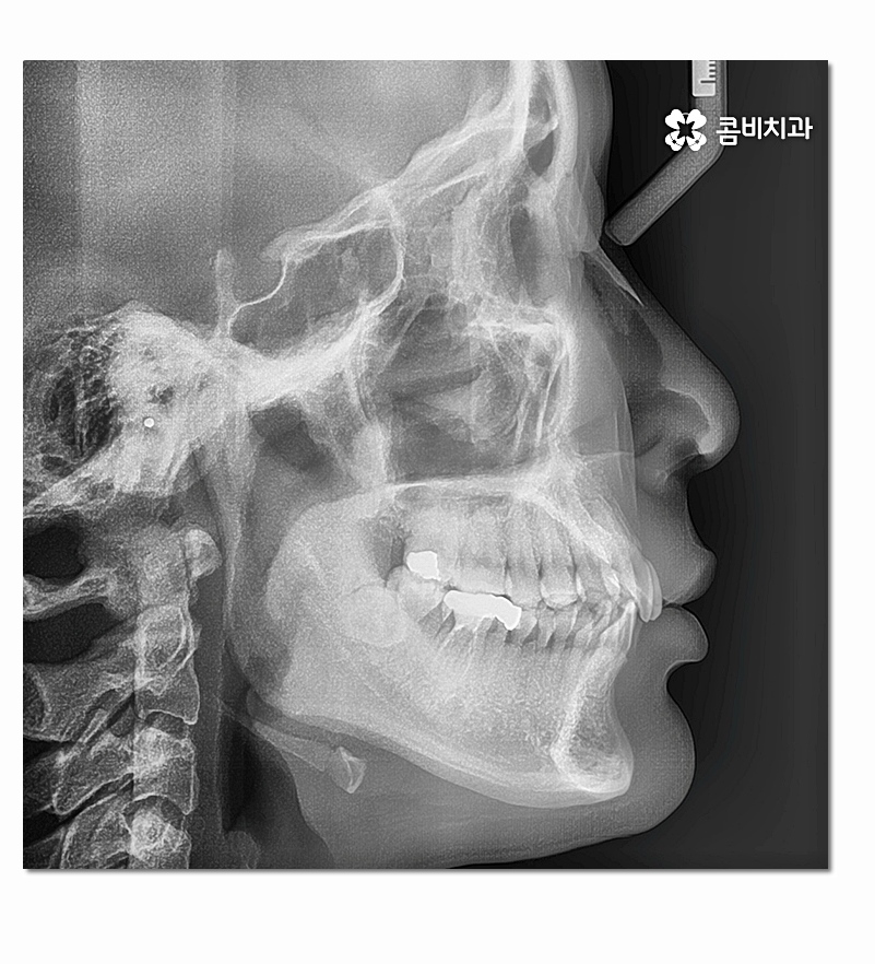 앞니 부분교정 오래 걸리지 않고 원하는 부위만 관련 이미지 5