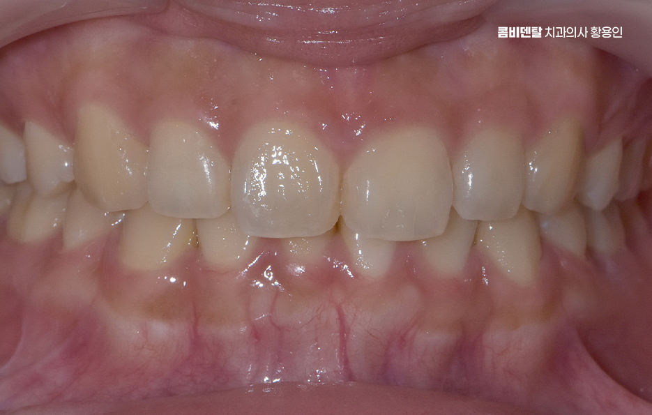 과개교합 교정 후 얼굴형 얼마나 바뀌나요 관련 이미지 2