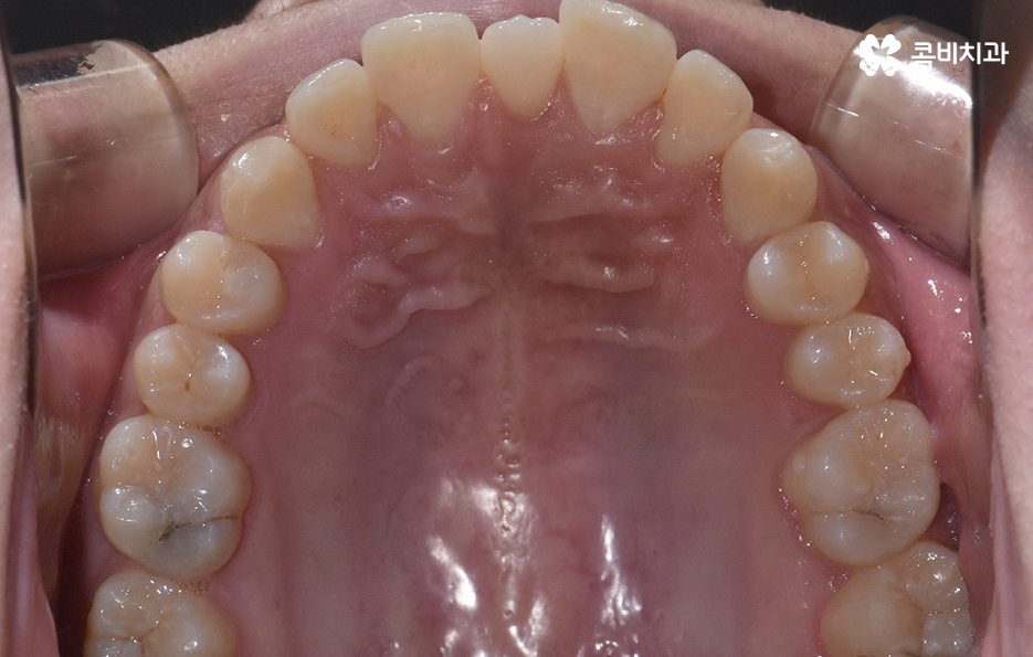 앞니만 교정 과잉치 뽑아서 해결했어요 관련 이미지 5