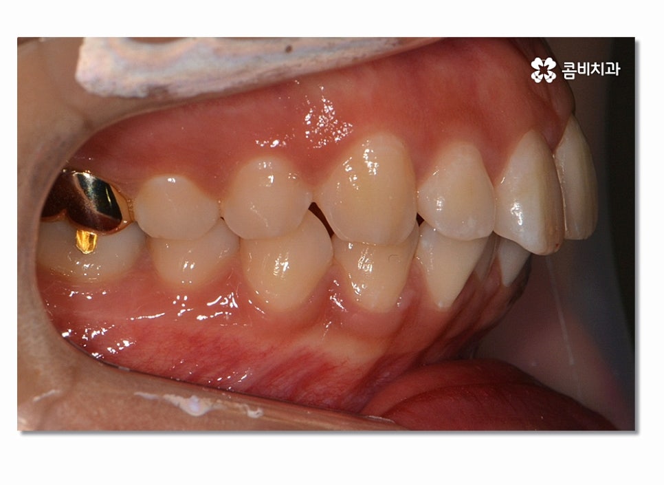 돌출입치아교정 부담이 크게 느껴진다면 관련 이미지 3