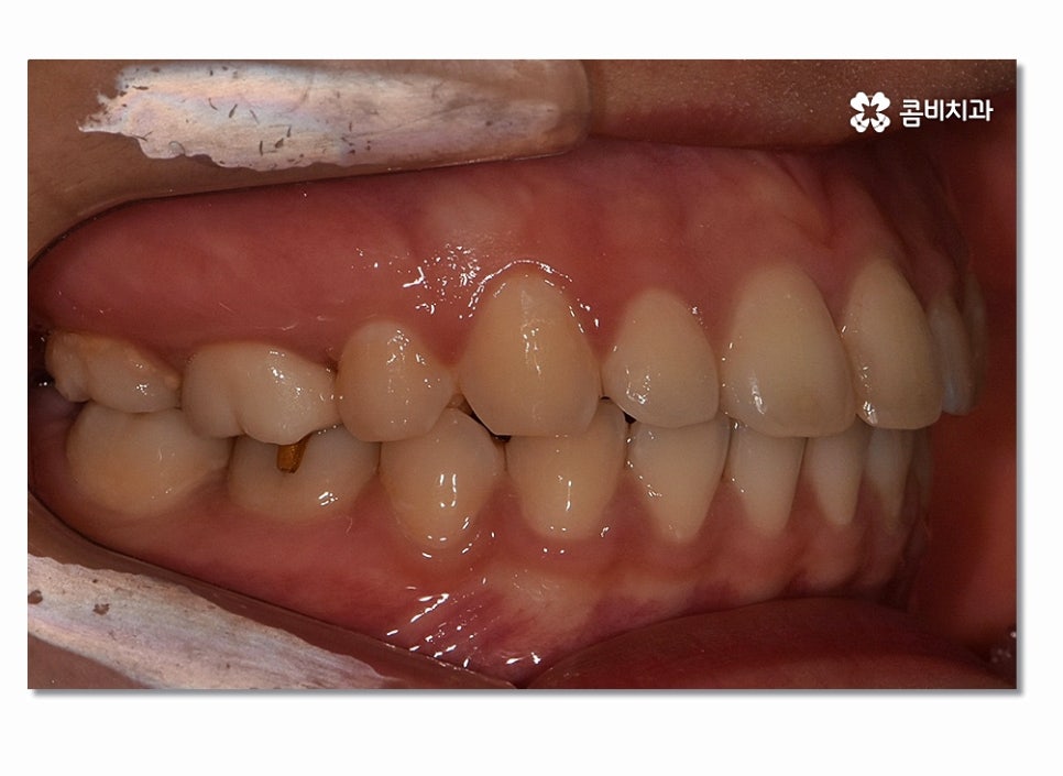 돌출입치아교정 부담이 크게 느껴진다면 관련 이미지 12
