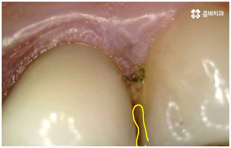 어금니신경치료 케이스마다 달라요 관련 이미지 8