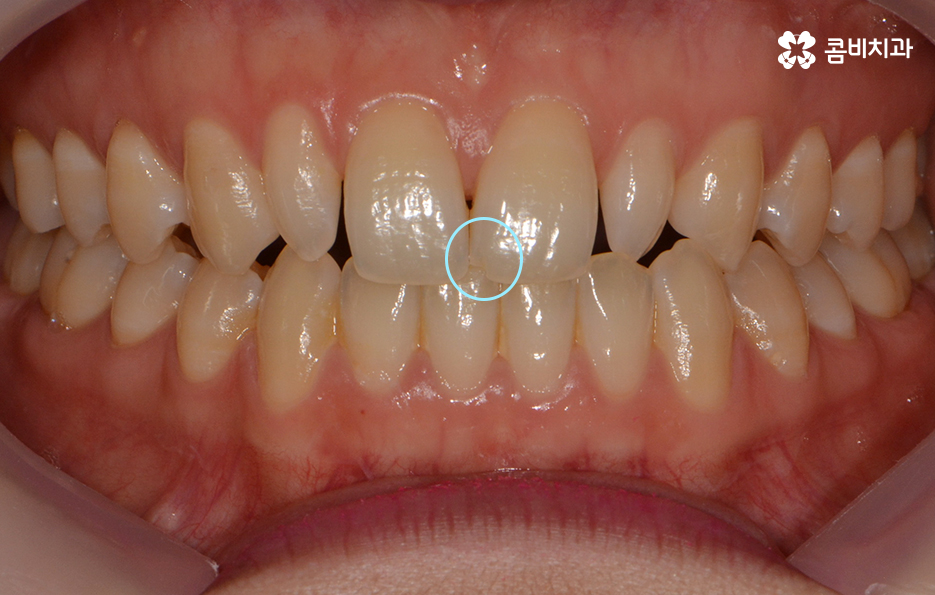 앞니 깨짐 치료와 교정이 병행되었던 사례 관련 이미지 1