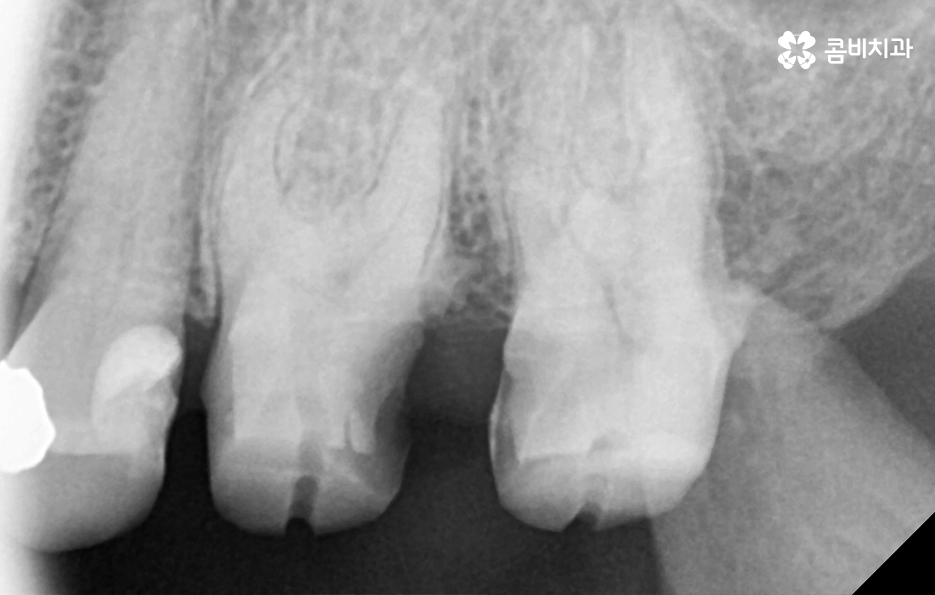 명동치과 놓치기 쉬운 2차충치에 주의하려면 관련 이미지 9