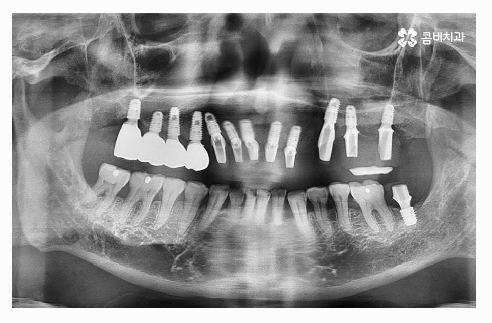 전체임플란트 신중하게 결정하려면 관련 이미지 8