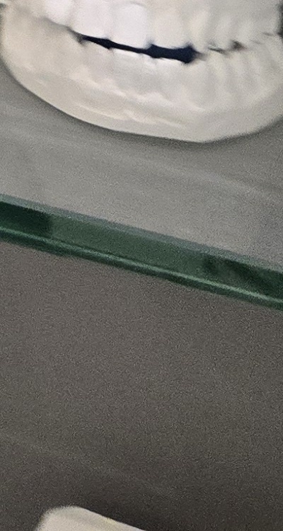 윗니 전체 임플란트 뭐부터 해야할까 관련 이미지 47