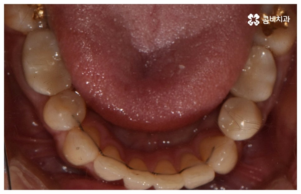 중년치아교정 원한다면 관련 이미지 20