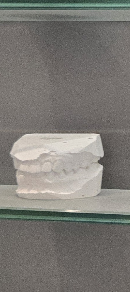 앞이빨 임플란트 과정 주의해야할 포인트는 관련 이미지 21