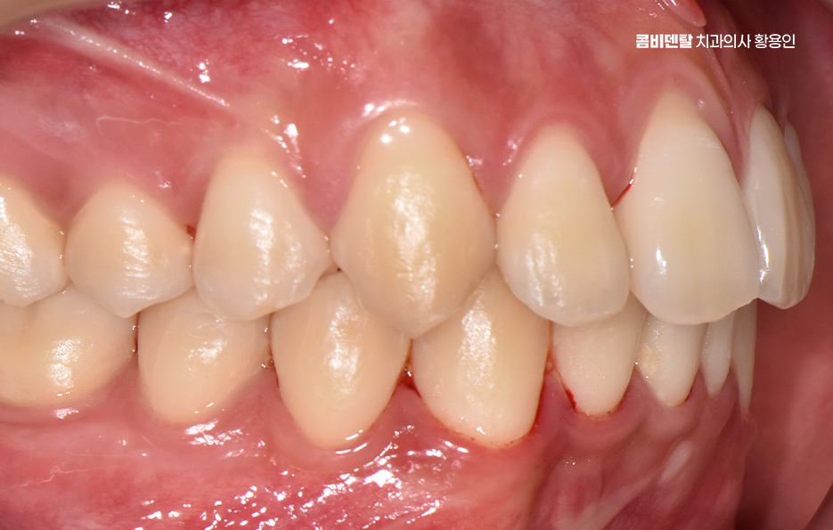 Can Crooked Lower Teeth Be Improved Without Extraction? image 8