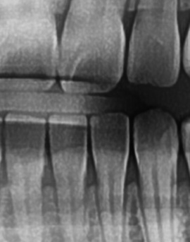 어금니 뒤 잇몸 부음 어떤 문제길래 이런거죠 관련 이미지 33