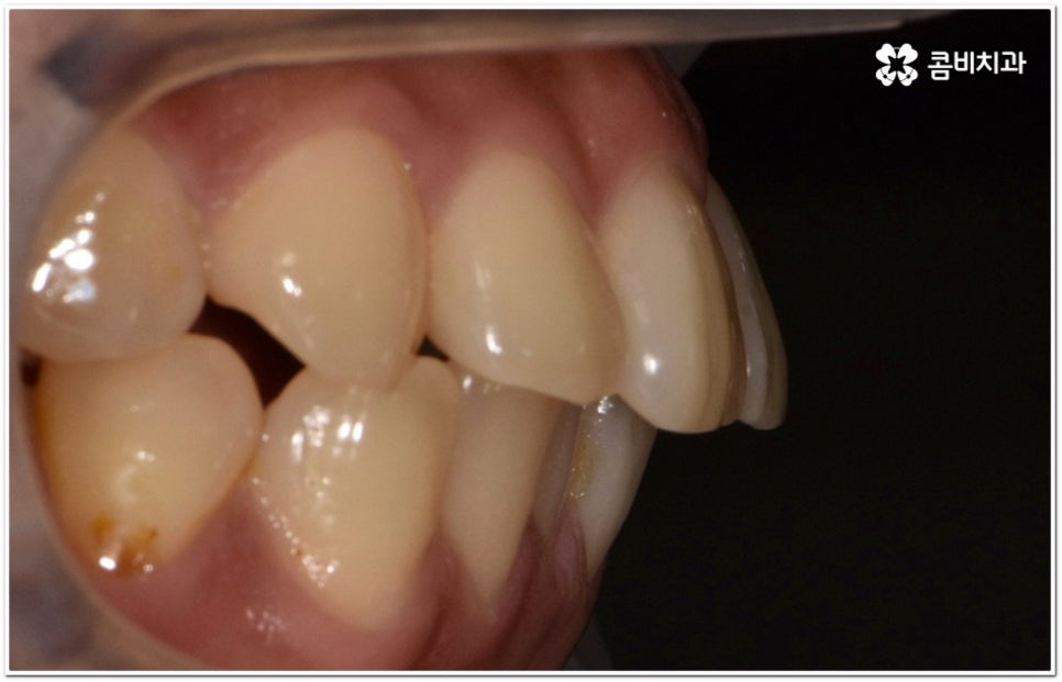 돌출입교정치과 알아보는 기준은 관련 이미지 4
