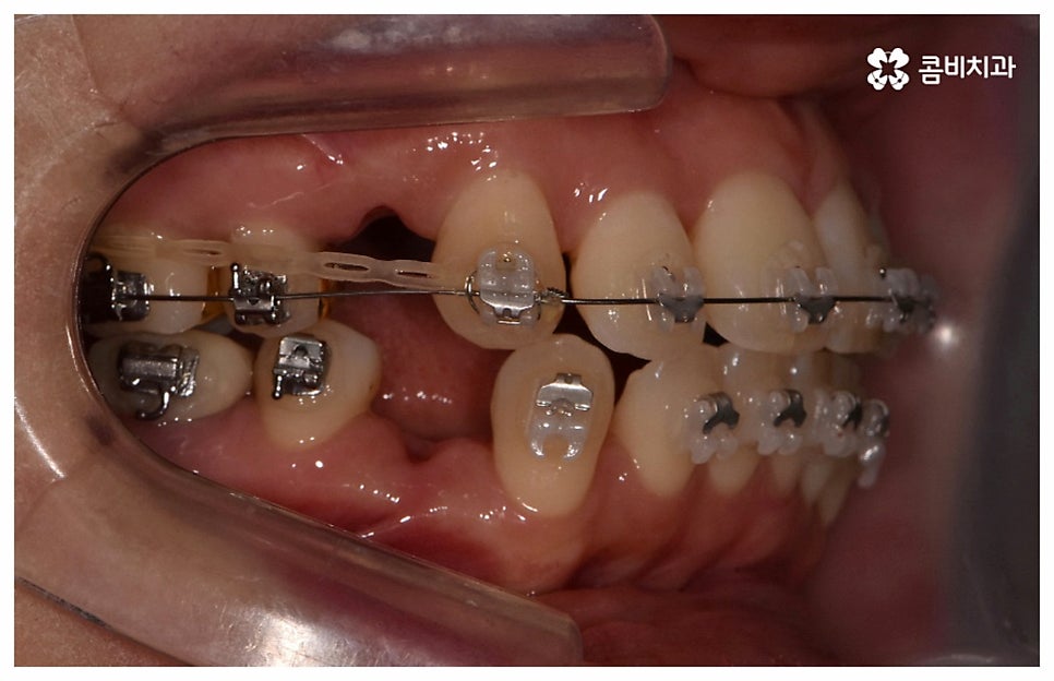 중년치아교정 원한다면 관련 이미지 7
