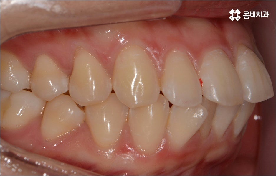 앞니 돌출 어떻게 고치나요? 관련 이미지 5