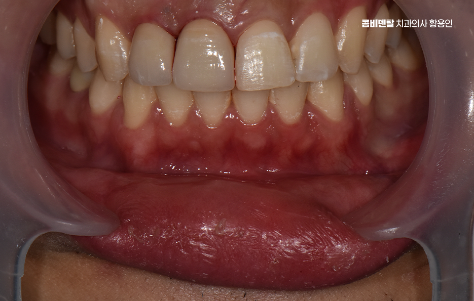 깨진 앞니 크라운 어떻게 해야 깔끔하게 해결될까 관련 이미지 10