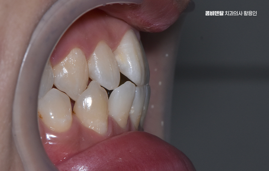 클리피씨교정 장단점 어떻게 비교하면 될까요 관련 이미지 3