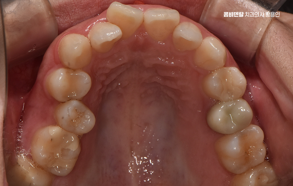 비발치 돌출입 교정 어떨때 적절할까 관련 이미지 5